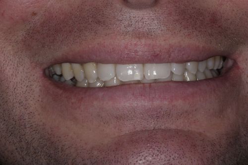 After dental implant treatment