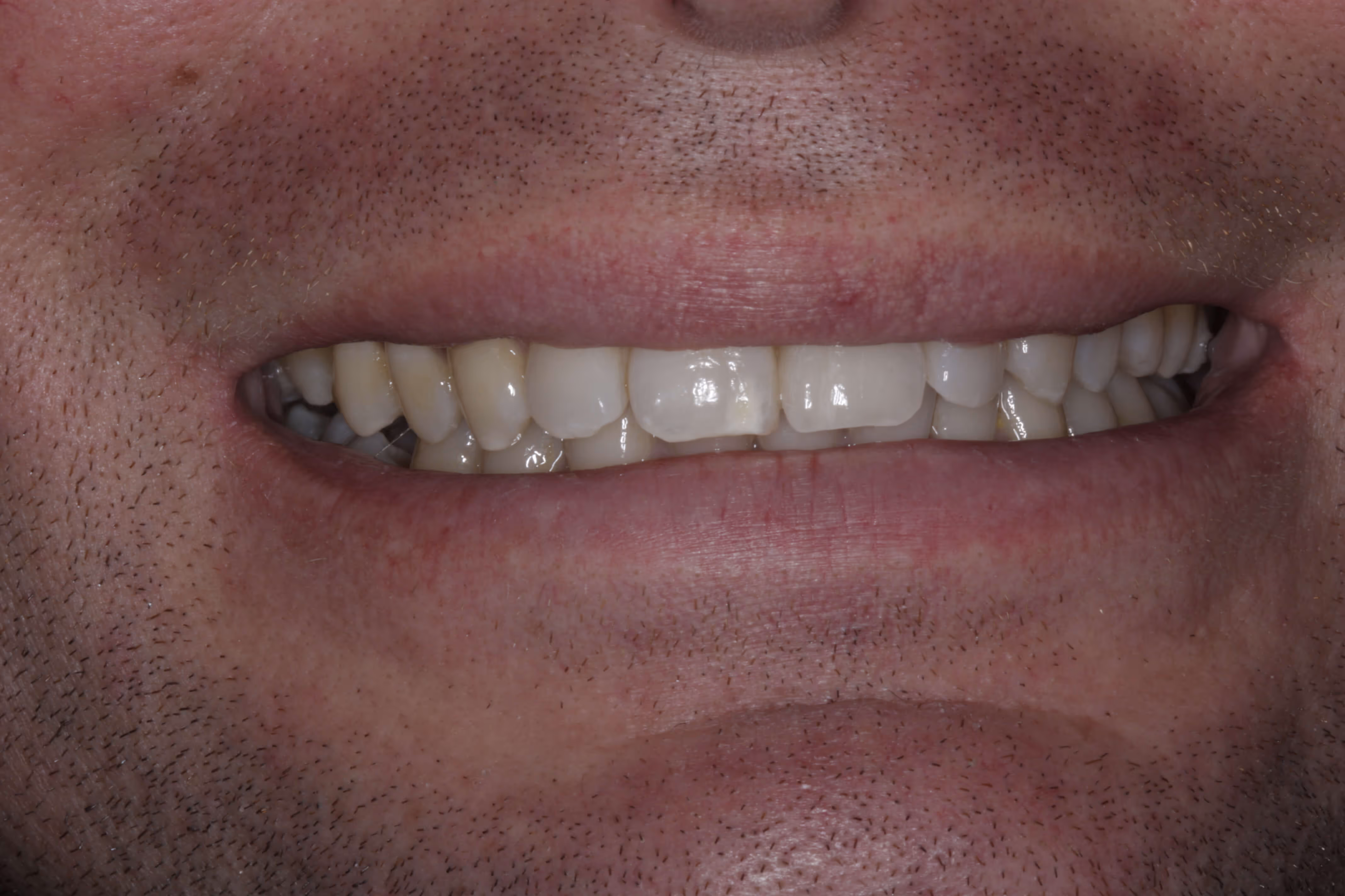 After dental implant treatment
