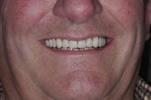 After full arch dental implant treatment