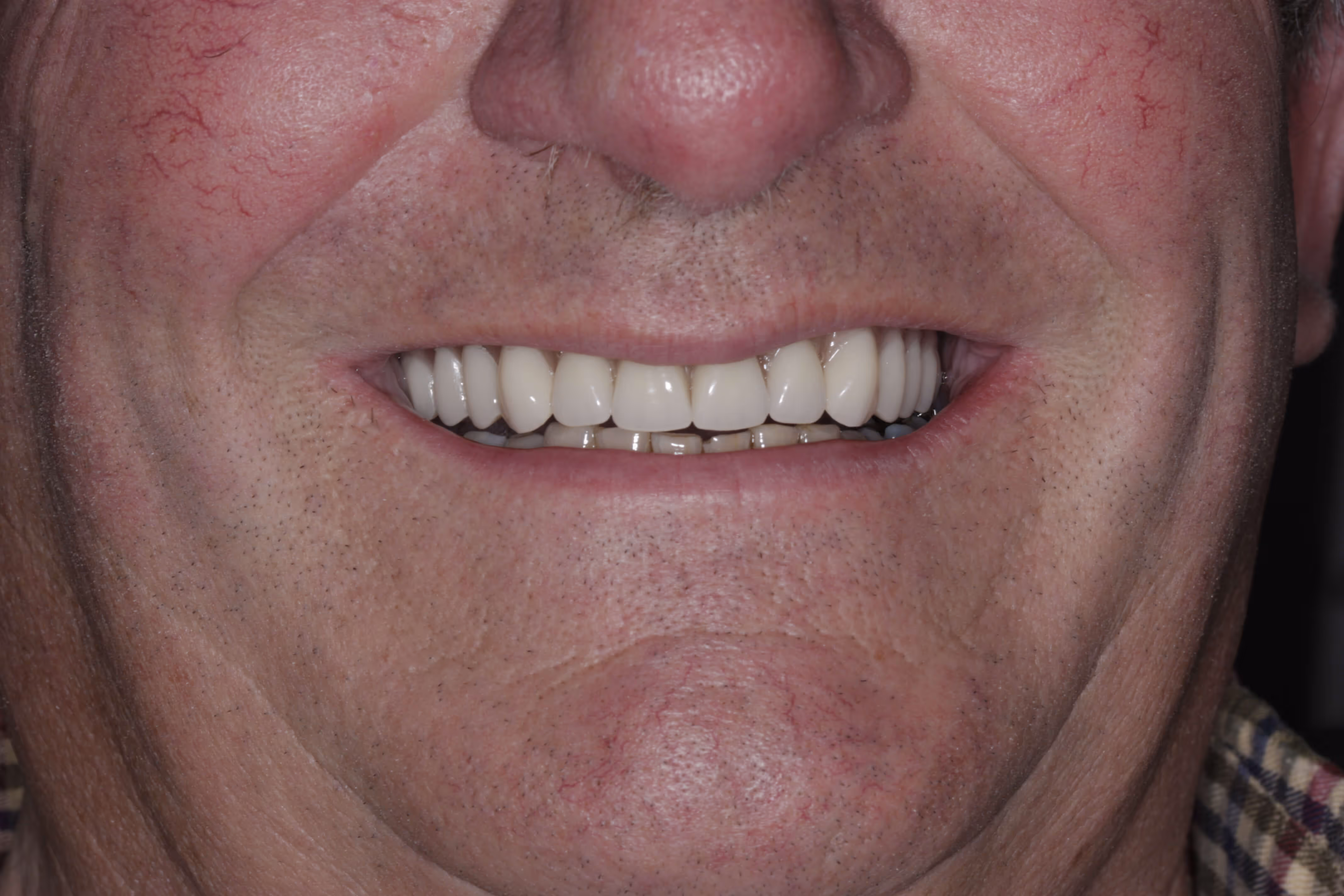 After full arch dental implant treatment