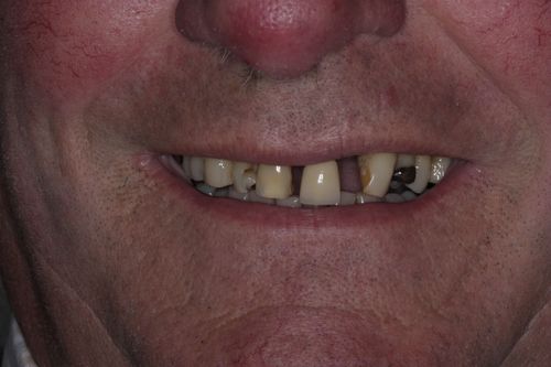 Before full arch dental implant treatment