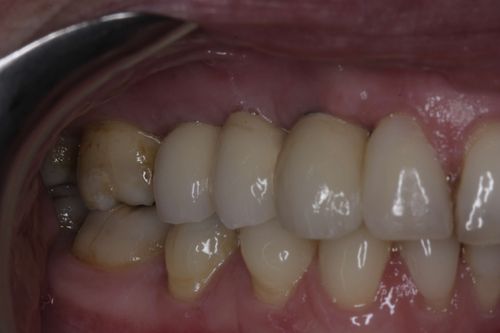 After multiple dental implant treatment