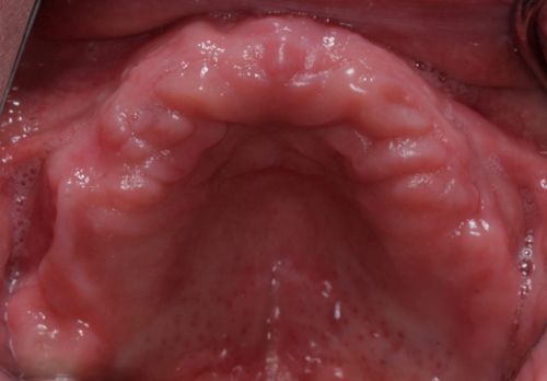 Full arch bridge with porcelain teeth