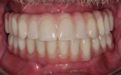After full arch dental implant treatment