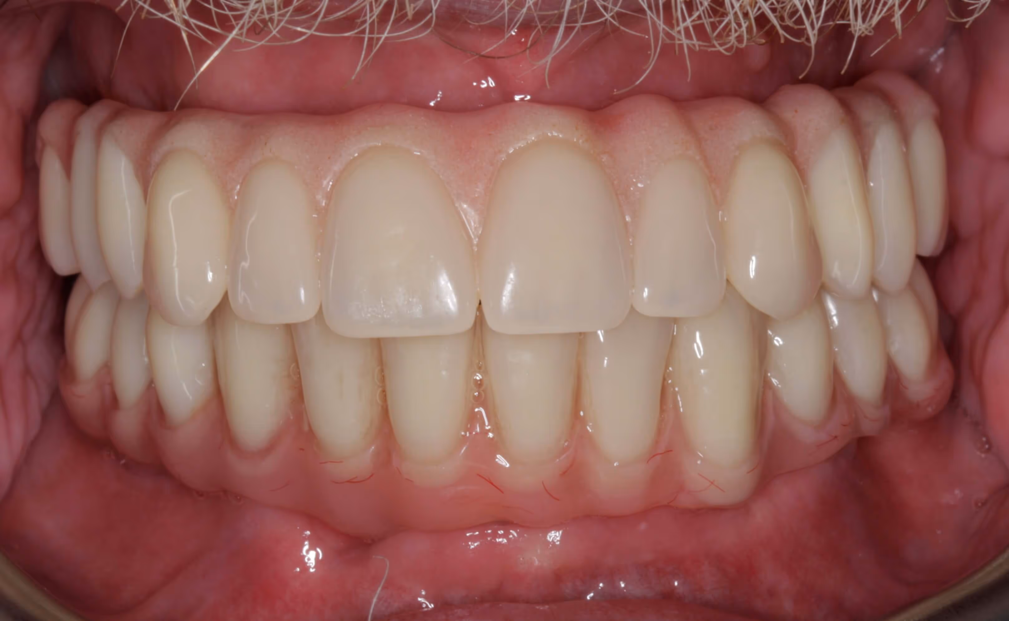 After full arch dental implant treatment