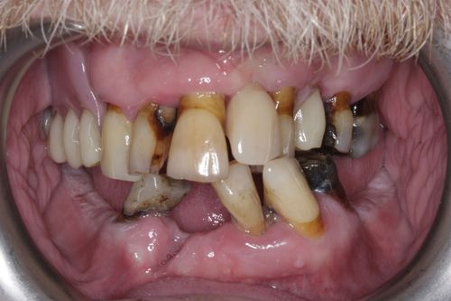 Before full arch dental implant treatment
