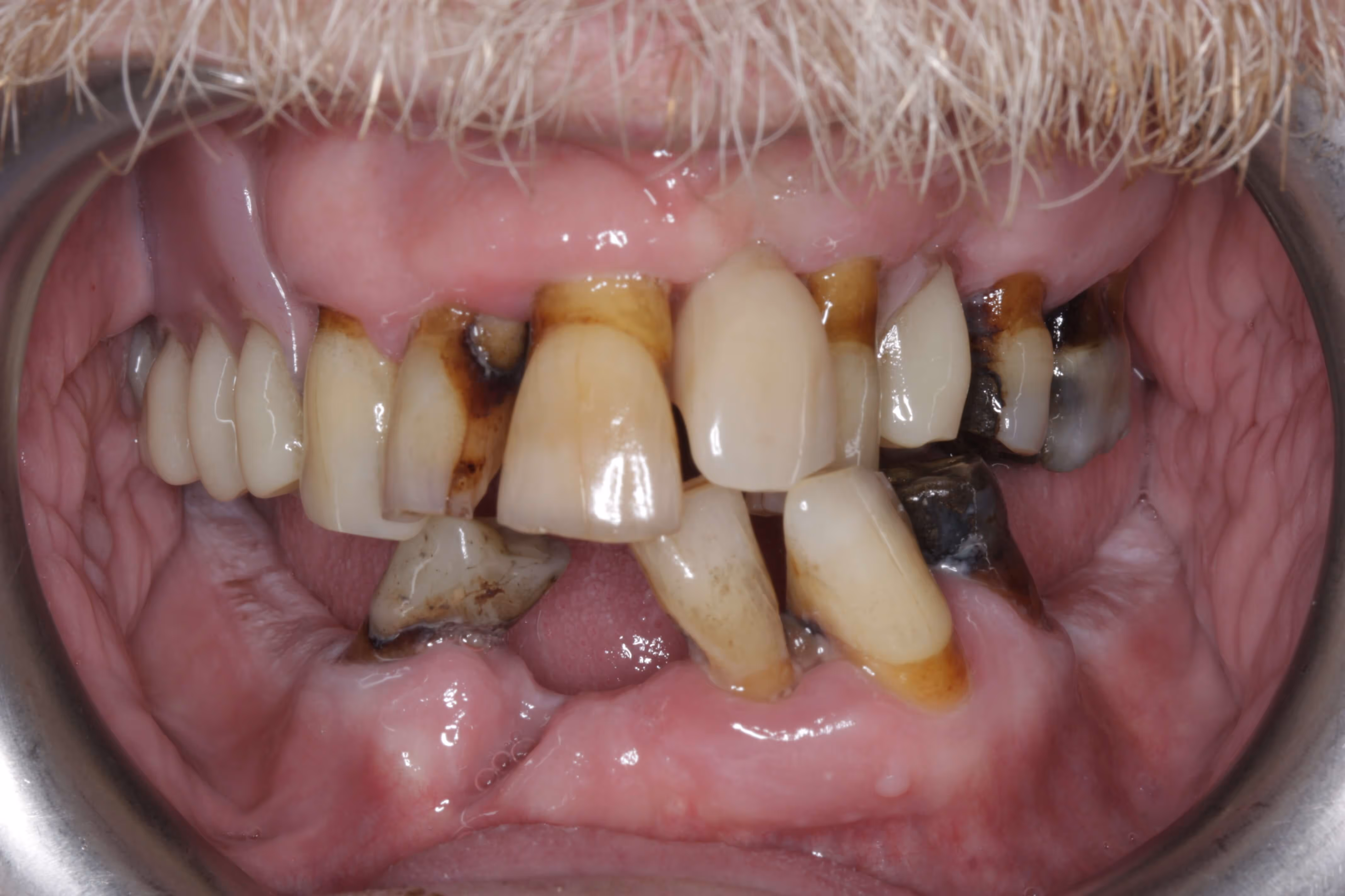 Before full arch dental implant treatment
