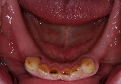 Full arch bridge with porcelain teeth