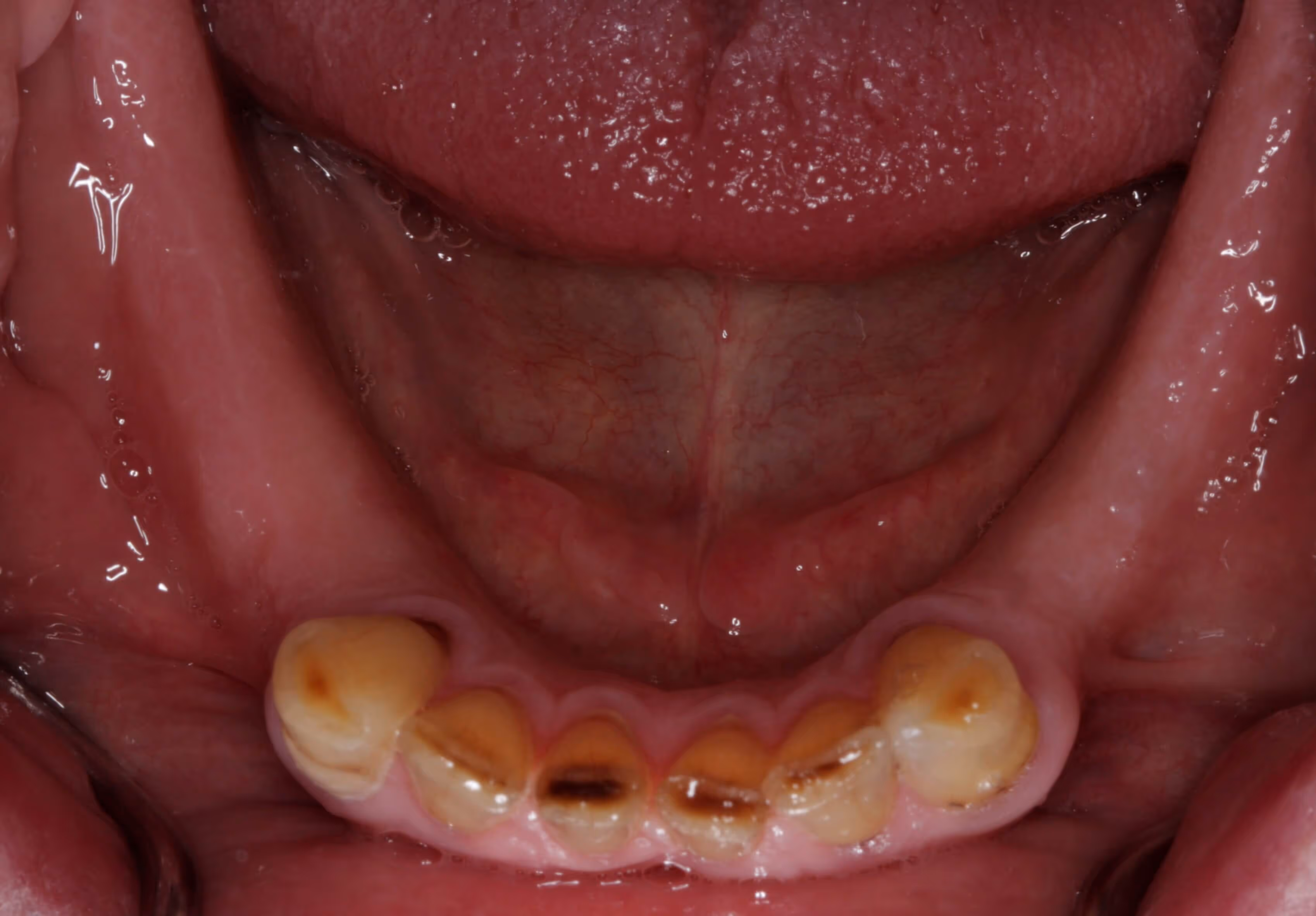 Full arch bridge with porcelain teeth