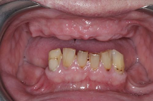 Full arch bridge with porcelain teeth