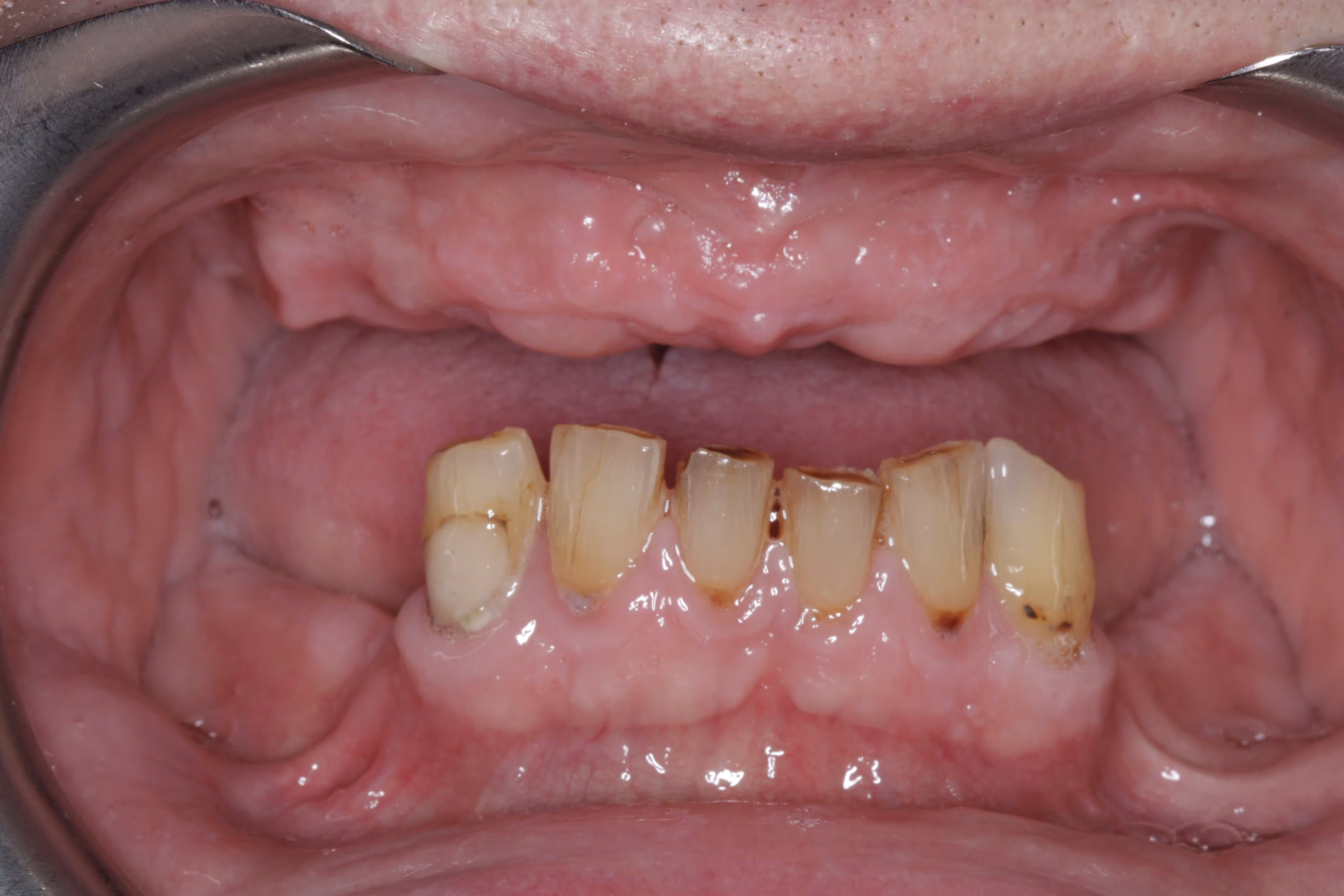 Full arch bridge with porcelain teeth