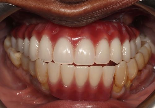 After a full arch (All-on-4) bridge with acrylic teeth