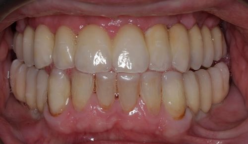 Full arch bridge with porcelain teeth