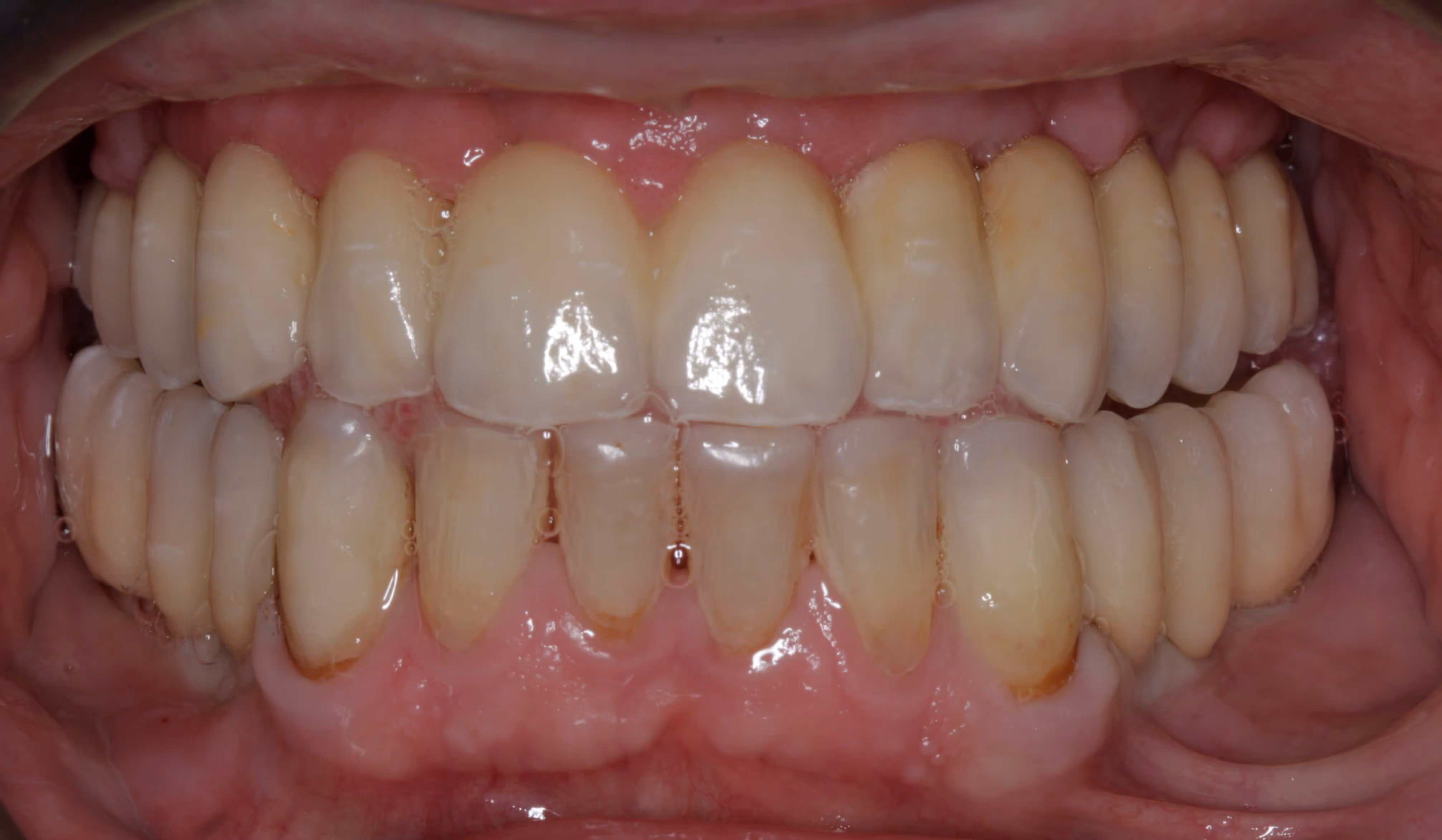 Full arch bridge with porcelain teeth