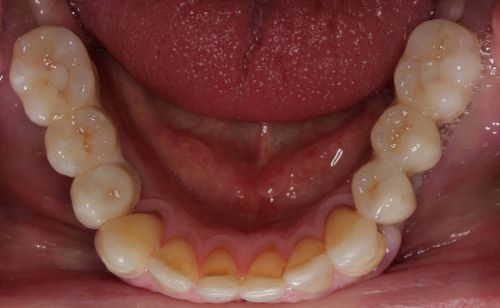 Full arch bridge with porcelain teeth