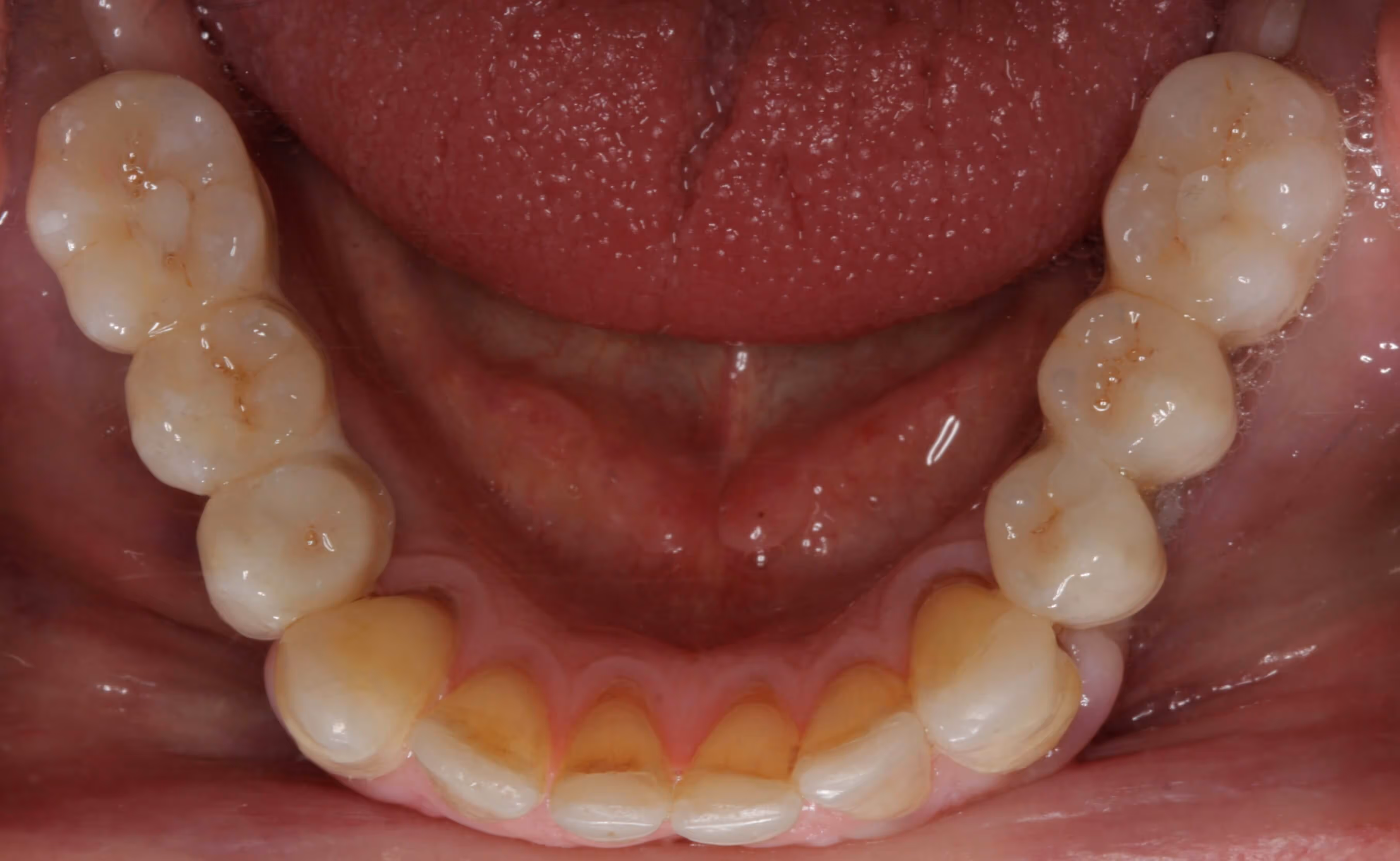 Full arch bridge with porcelain teeth