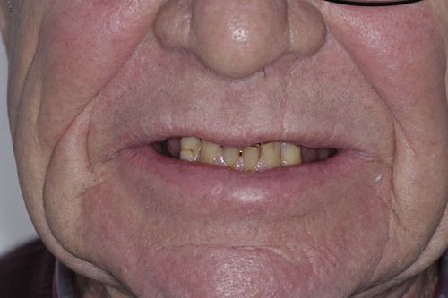 Full arch bridge with porcelain teeth