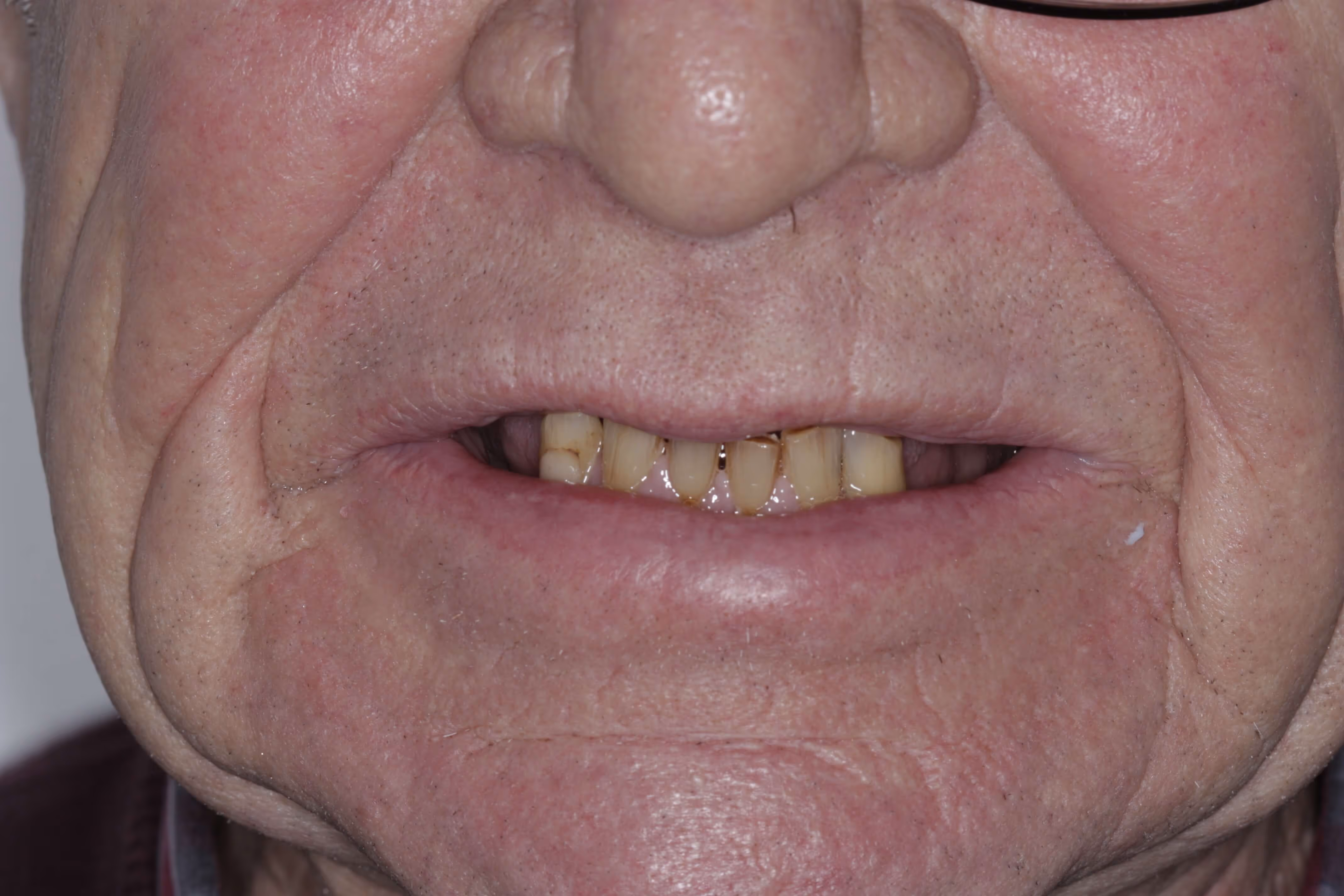 Full arch bridge with porcelain teeth