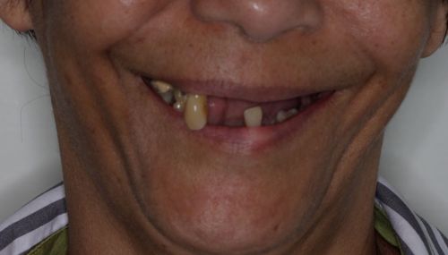 Bar-supported dentures