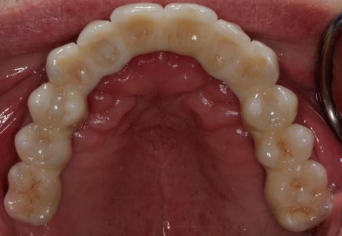 Full arch bridge with porcelain teeth