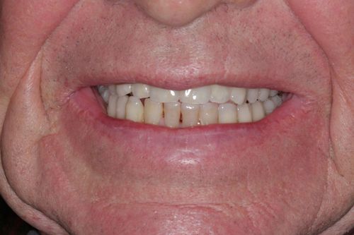 Full arch bridge with porcelain teeth