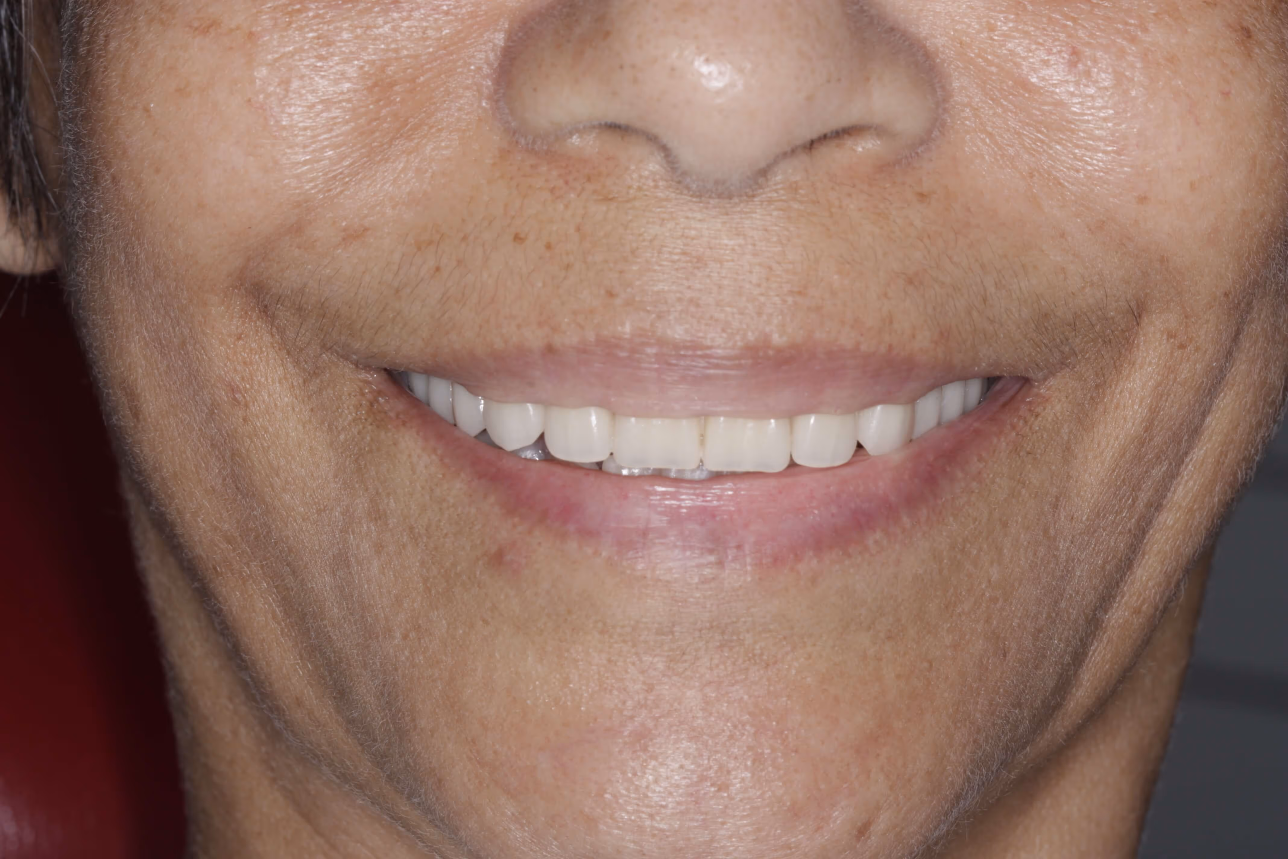 Bar-supported dentures