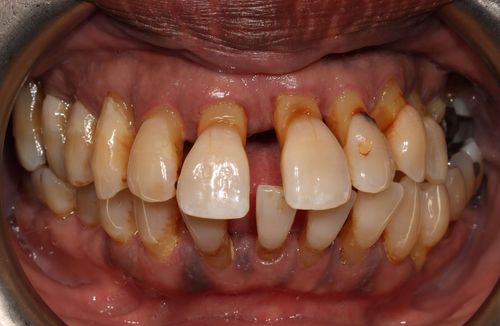 Before a full arch (All-on-4) bridge with acrylic teeth