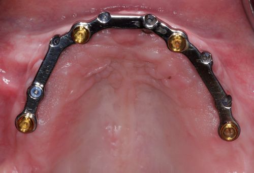 Bar-supported dentures