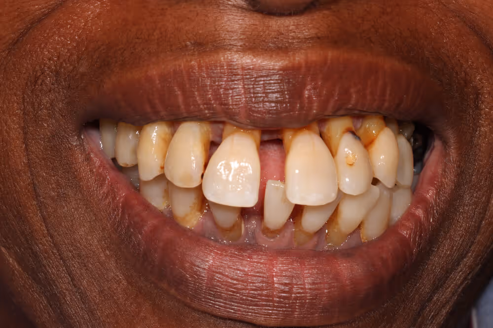 Before a full arch (All-on-4) bridge with acrylic teeth