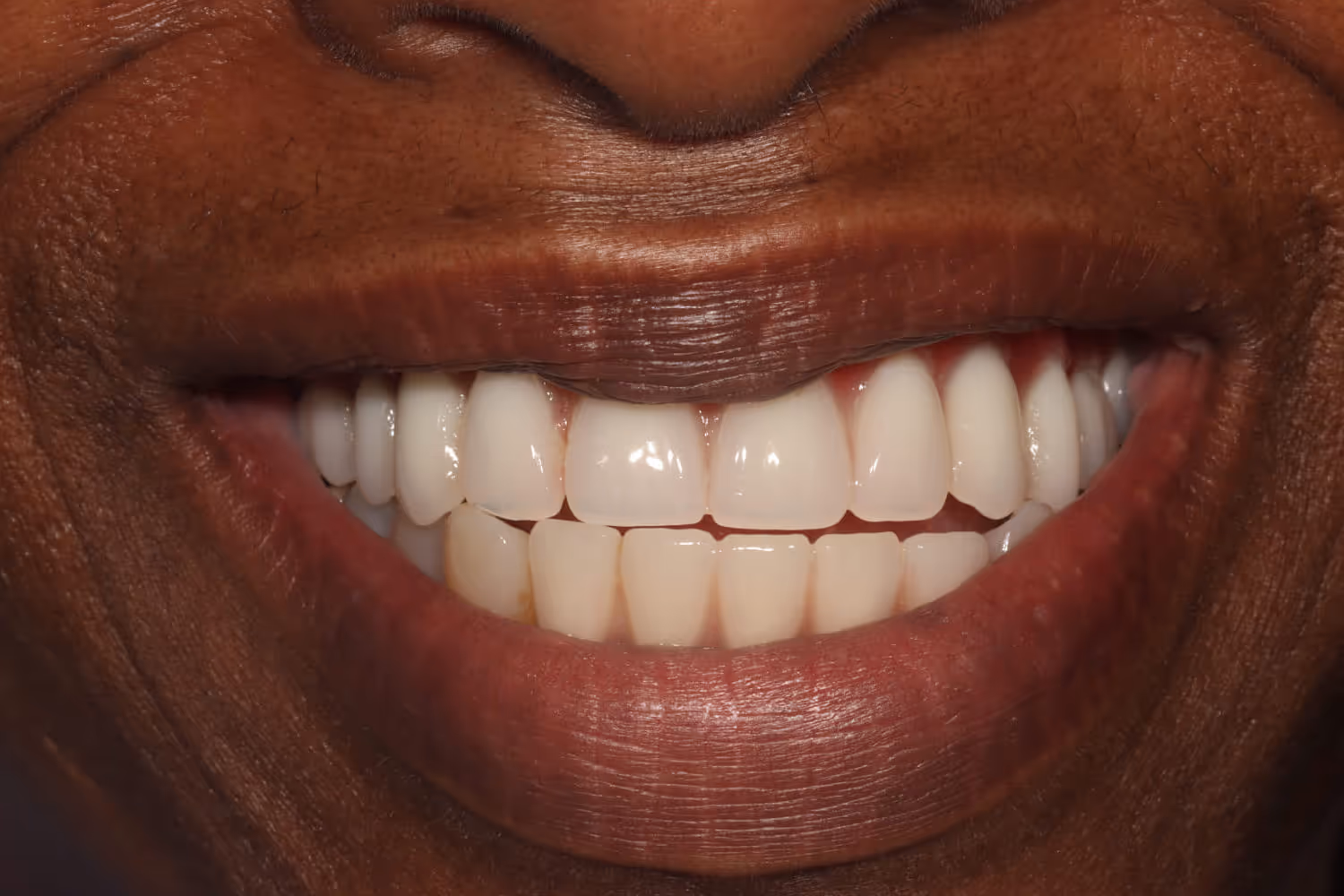 After a full arch (All-on-4) bridge with acrylic teeth