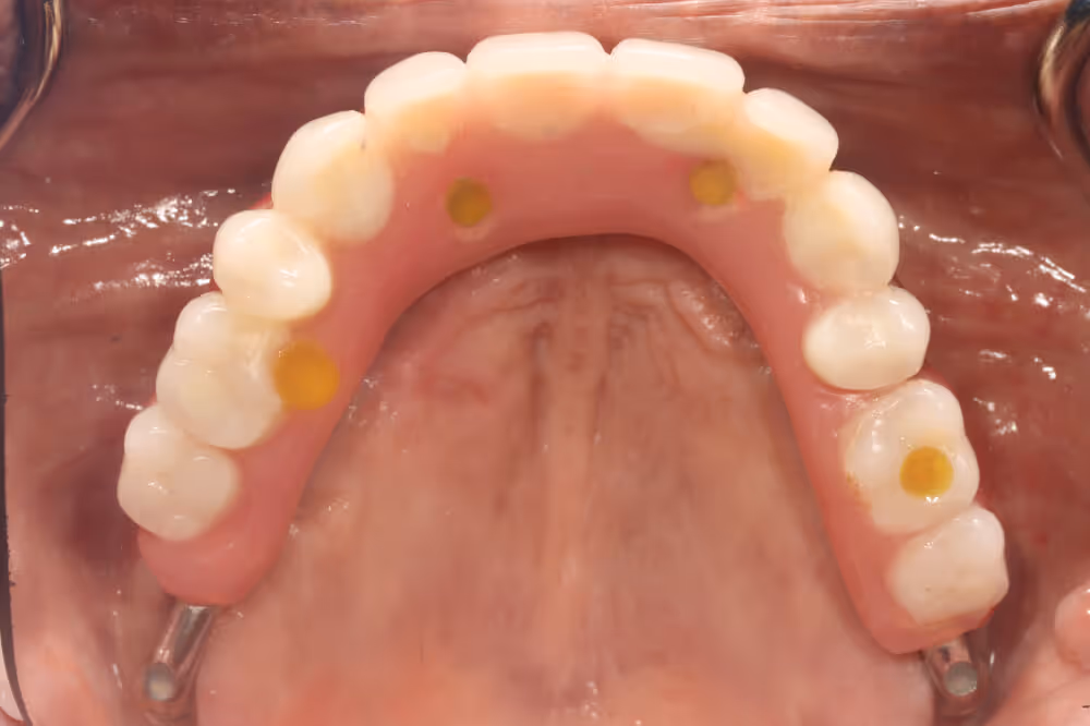 Full arch (All-on-4) bridge with acrylic teeth