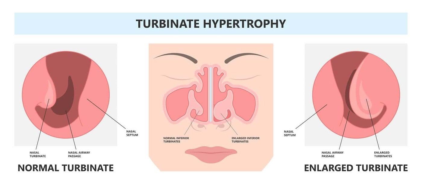 Large Inferior Turbinate: Symptoms, Causes, Diagnosis, and Treatment