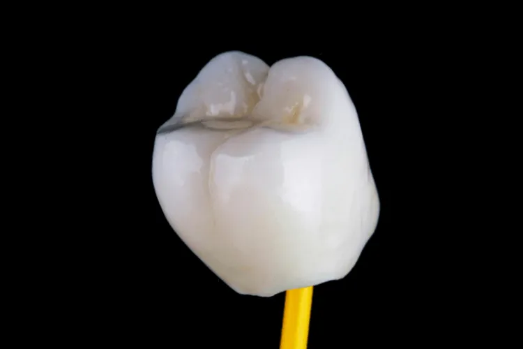 kiedy-wybrac-korone-porcelanowa-po-leczeniu-kanalowym