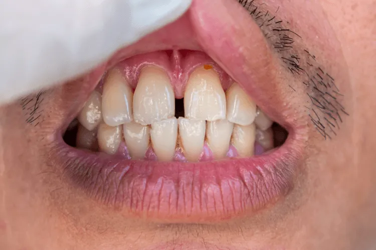 diastema-jak-wyglada-diagnostyka-i-plan-leczenia