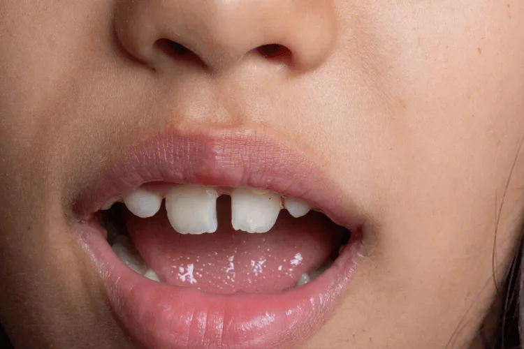 diastema-u-dzieci-kiedy-rozpoczac-leczenie