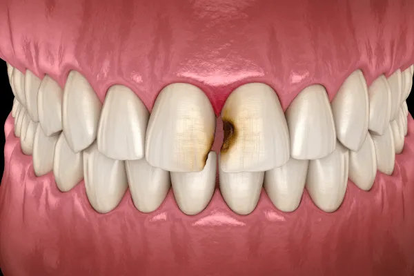 prochnica-miedzy-zebami-objawy