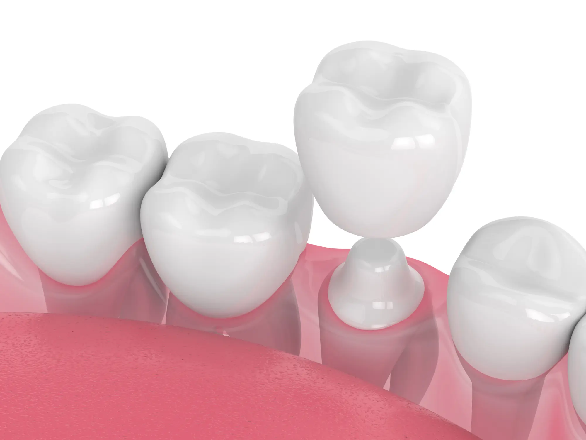 Broken Crowns and Lost Fillings: Quick Weekend Repairs at Gardner Wade DDS