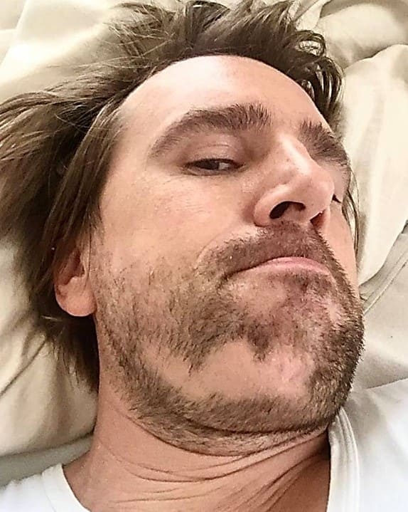 Kreisrunder Haarausfall