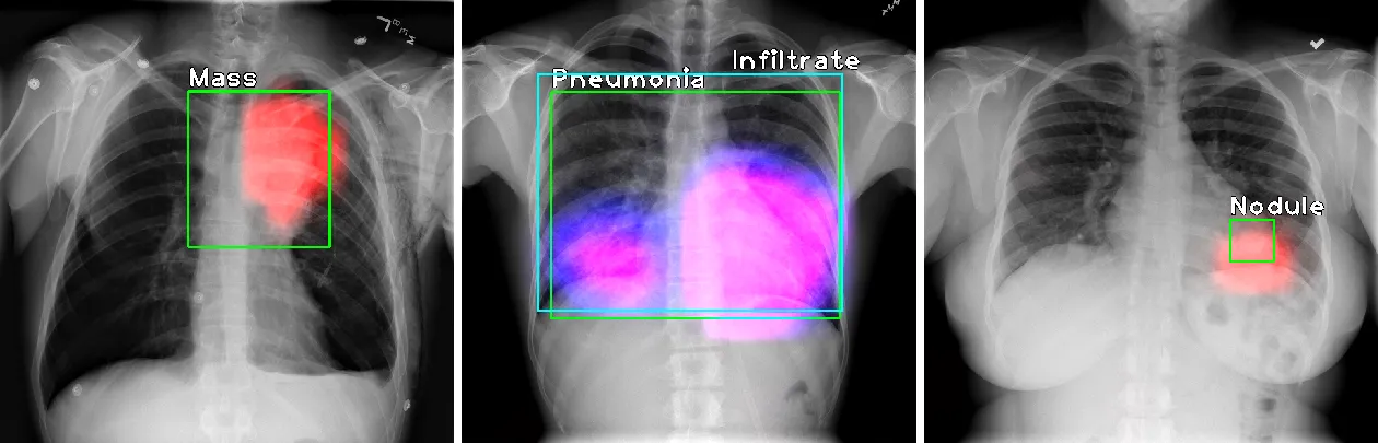 AI Model Training for Enhanced Chest X-ray Nodule Detection and Characterization