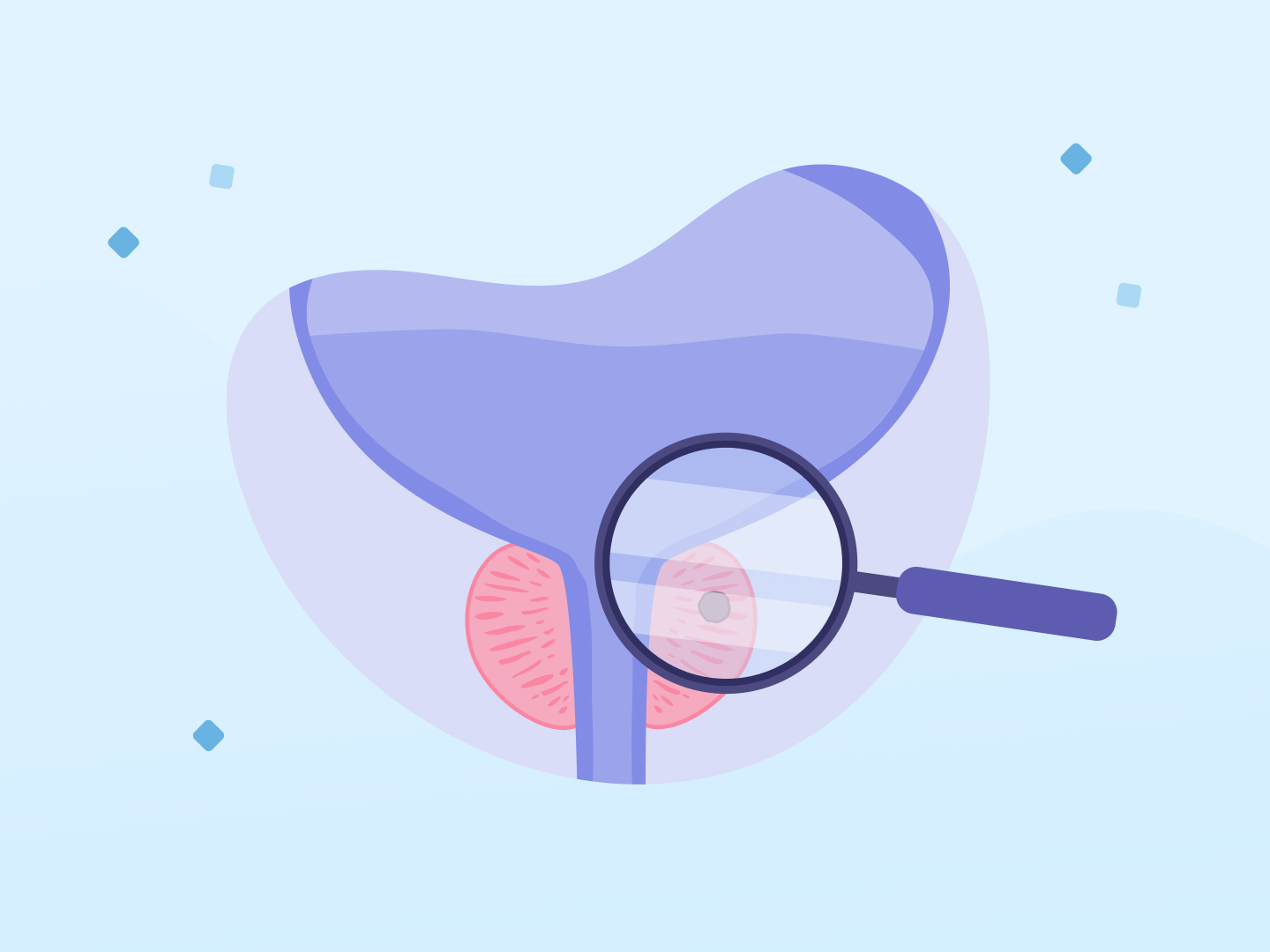 Eine Lupe deutet auf einen Tumor in der Prostata hin, die unter der Blase sitzt.