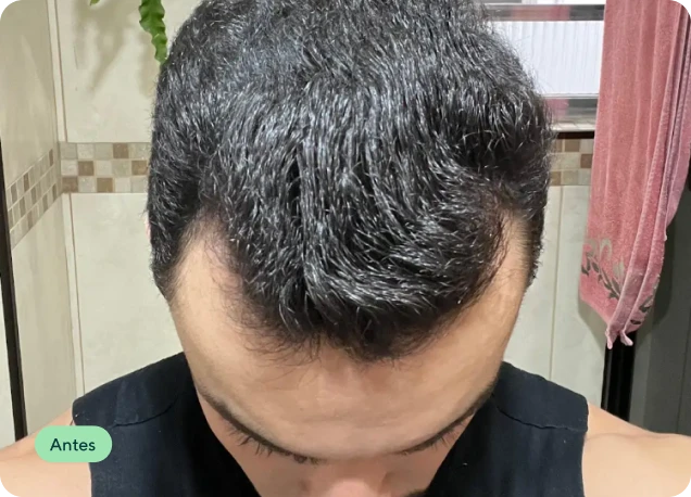 Couro cabeludo no mês 6