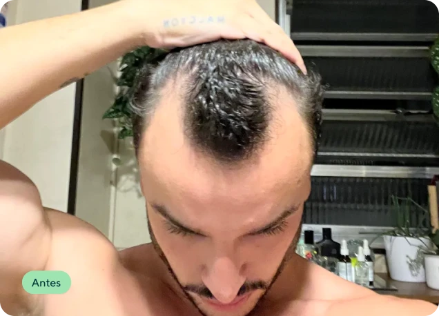 Couro cabeludo no mês 1