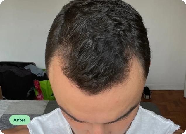 Couro cabeludo no mês 3