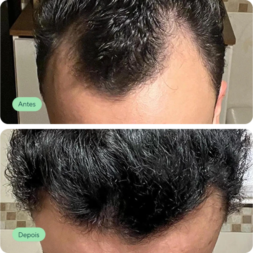 Antes e depois de um paciente após o tratamento capilar