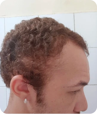 Francisco Augusto depois do tratamento