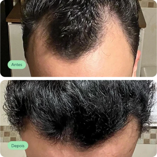 Antes e depois de um paciente após o tratamento capilar