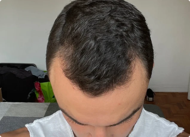 Couro cabeludo no mês 3