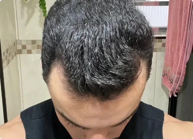 Couro cabeludo no mês 6