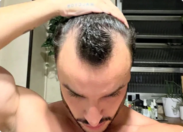 Couro cabeludo no mês 1