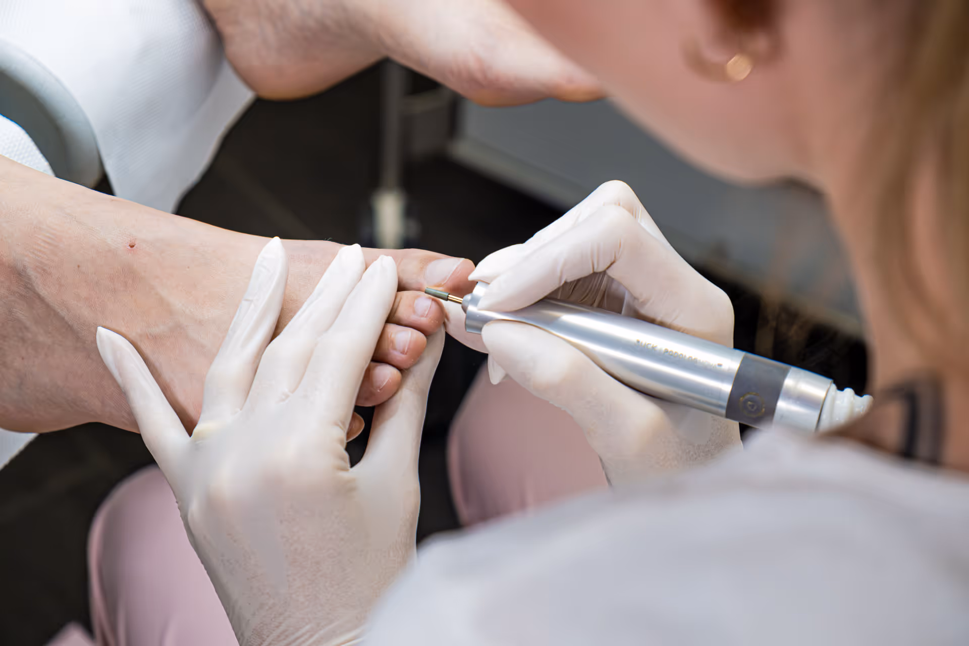 Podologin trägt Handschuhe und bearbeitet einen Zeh mit einem elektrischen Fräser.